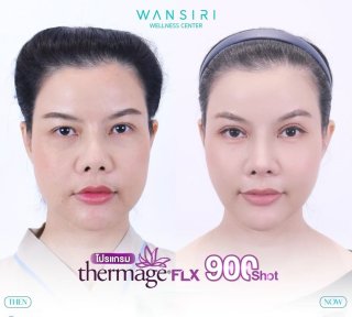 Результаты до и после Thermage FLX в Wansiri Hospital – улучшение подтяжки лица