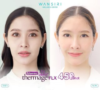 Результаты до и после Thermage FLX в Wansiri Hospital, видимое подтяжка кожи лица