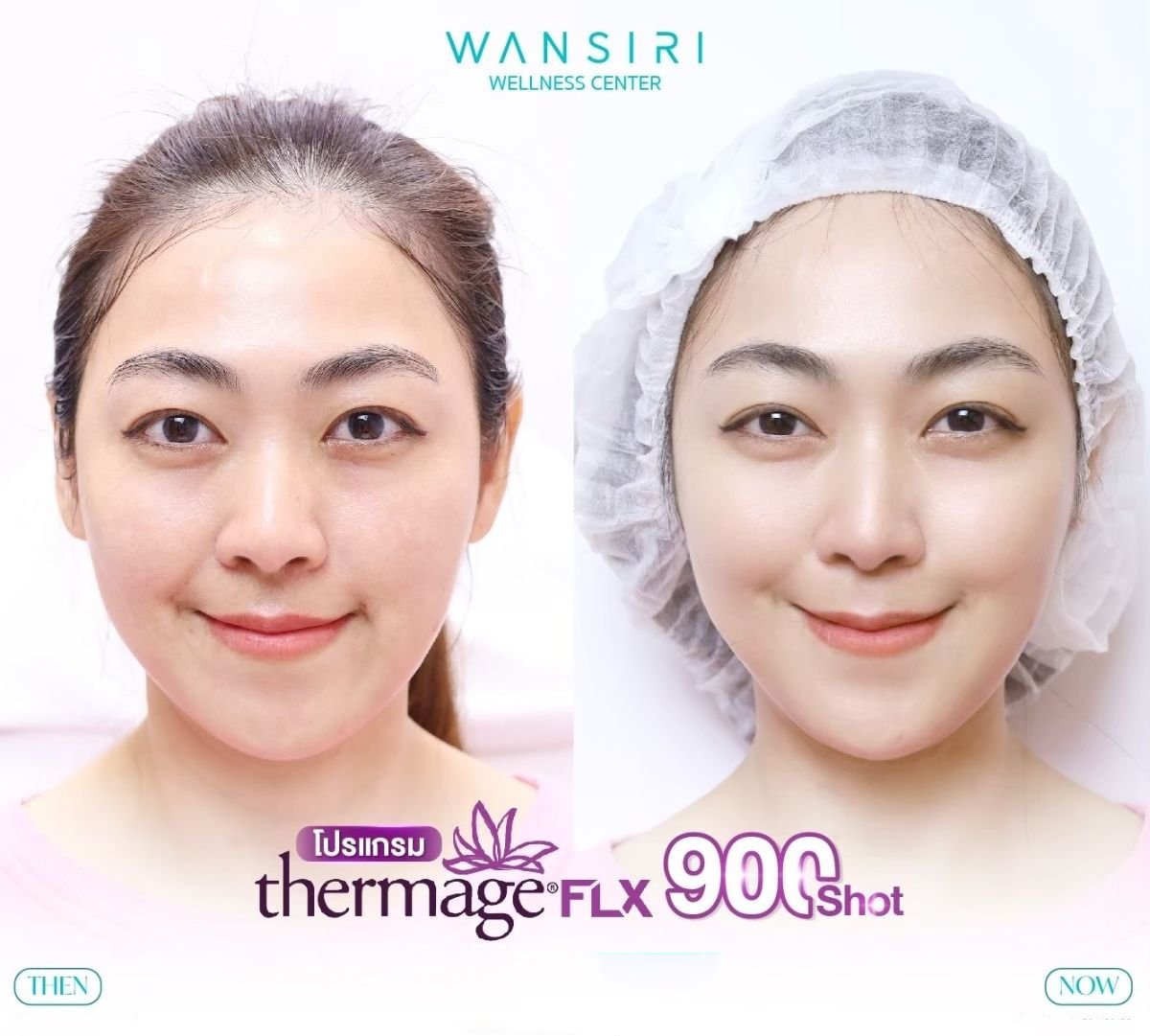 Resultados antes y después de Thermage FLX en Wansiri Hospital: piel facial más firme