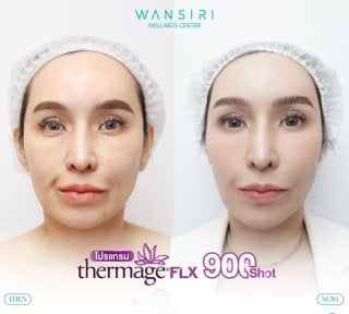 Результаты до и после Thermage FLX в Wansiri Hospital, улучшение упругости кожи лица