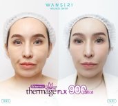 Результаты до и после Thermage FLX в Wansiri Hospital, улучшение упругости кожи лица