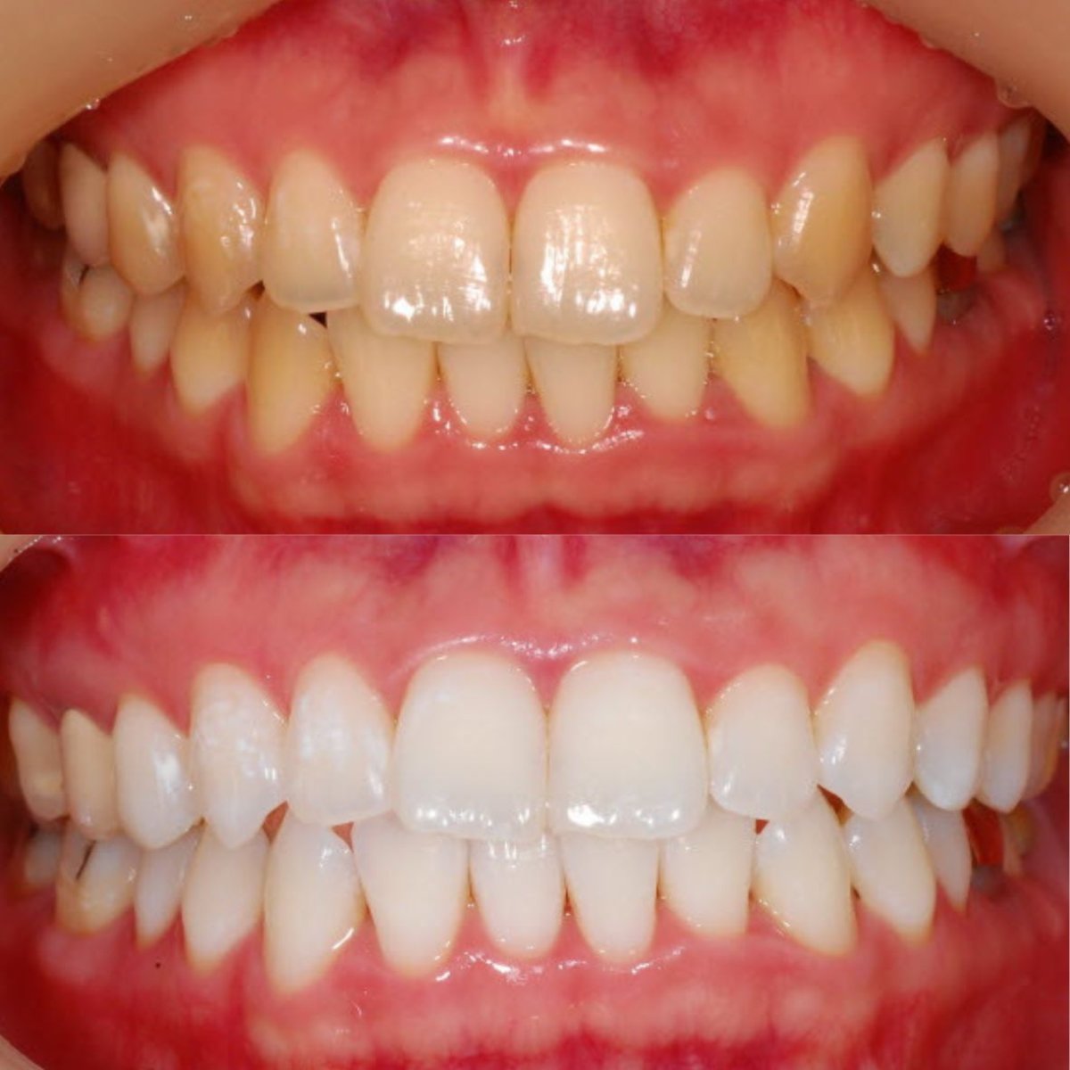 نتائج تبييض الأسنان قبل وبعد في S-plant Dental Hospital، ابتسامة أكثر إشراقًا