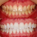 Vorher-nachher-Ergebnis Zahnaufhellung bei S-plant Dental Hospital, sichtbar helleres Lächeln