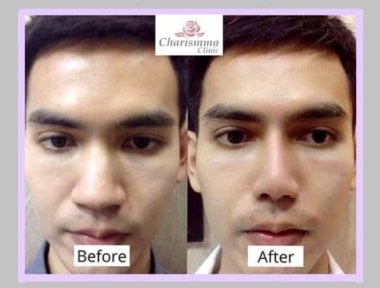 Before and after alarplasty results at Charismma Clinic, improved nose shape and symmetry