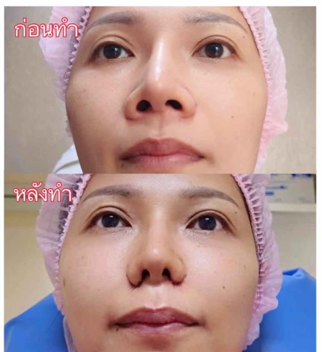 Before and after alarplasty results at Charismma Clinic, nose reshaping with refined nostrils