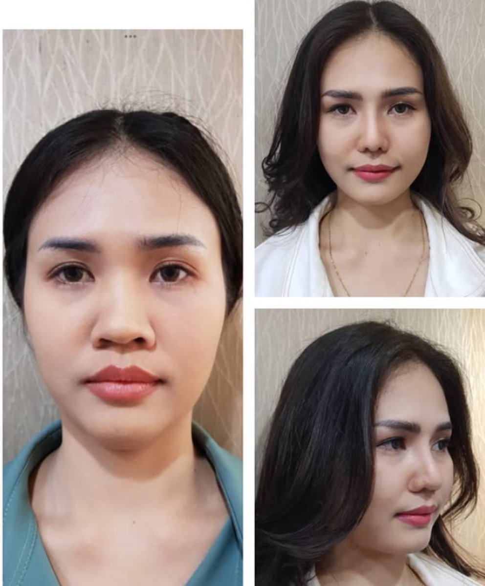 Before and after alarplasty results at Charismma Clinic, nose reshaping with refined contour