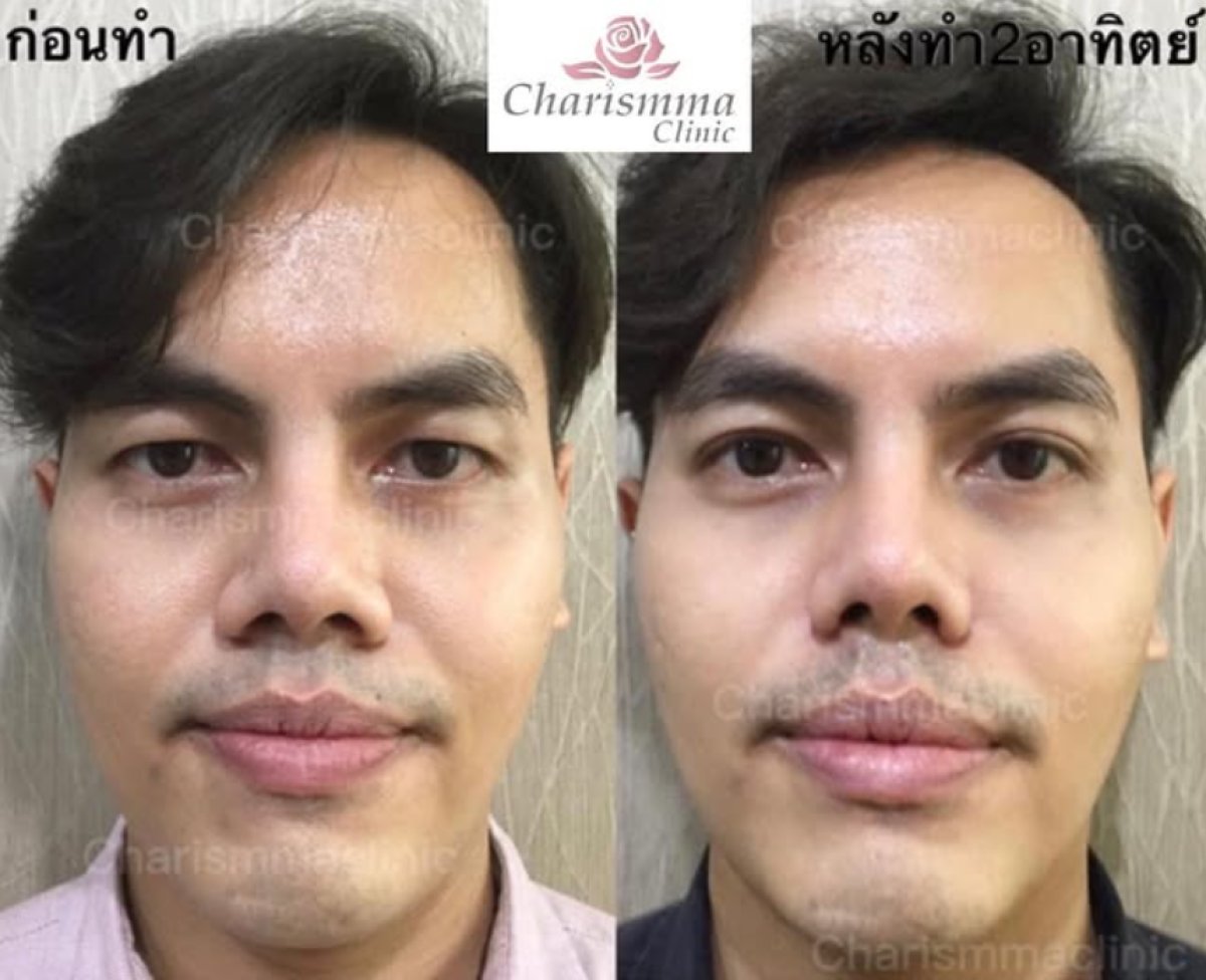 Resultados de alarplastia antes y después en Charismma Clinic, remodelación de las fosas nasales