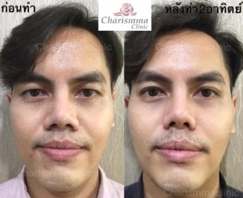 Before and after alarplasty results at Charismma Clinic, nose reshaping for refined nostrils