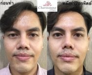 Before and after alarplasty results at Charismma Clinic, nose reshaping for refined nostrils