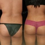 Before and after 360 liposuction results at Memorial Bahçelievler Hospital, body contouring