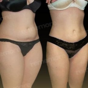 Before and after 360 liposuction results at Memorial Bahçelievler Hospital, body contouring