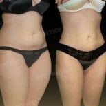 Before and after 360 liposuction results at Memorial Bahçelievler Hospital, body contouring