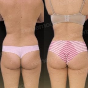Before and after 360 liposuction results at Memorial Bahçelievler Hospital, body contouring