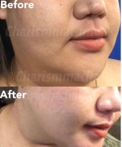 Before and after chin liposuction results at Charismma Clinic, improved jawline contour