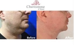 Before and after chin liposuction results at Charismma Clinic, improved jawline contour