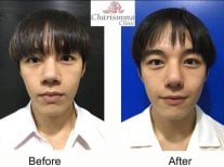 Before and after alarplasty results at Charismma Clinic, nose reshaping for refined nostrils