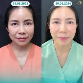 Résultats avant/après lifting non chirurgical au Anjali Clinic – rajeunissement du visage