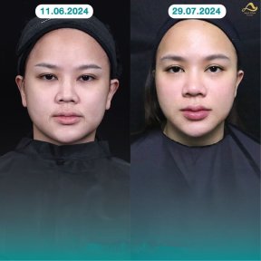 Resultados antes y después de lifting facial sin cirugía en Anjali Clinic – mejora del contorno