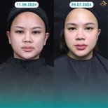 Resultados antes y después de lifting facial sin cirugía en Anjali Clinic – mejora del contorno