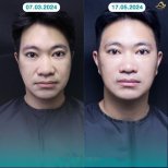 Resultados antes y después de lifting facial sin cirugía en Anjali Clinic, rejuvenecimiento facial