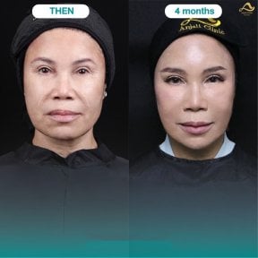 Nonsurgical facelift before and after results at Anjali Clinic, visible facial rejuvenation