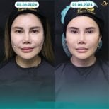 Before and after nonsurgical facelift results at Anjali Clinic, facial rejuvenation visible