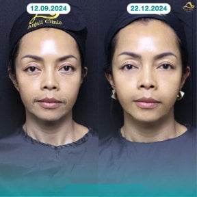 Before and after nonsurgical facelift results at Anjali Clinic, visible facial rejuvenation