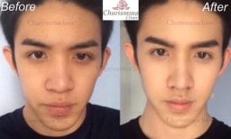Before and after alarplasty results at Charismma Clinic, visible nose reshaping improvement
