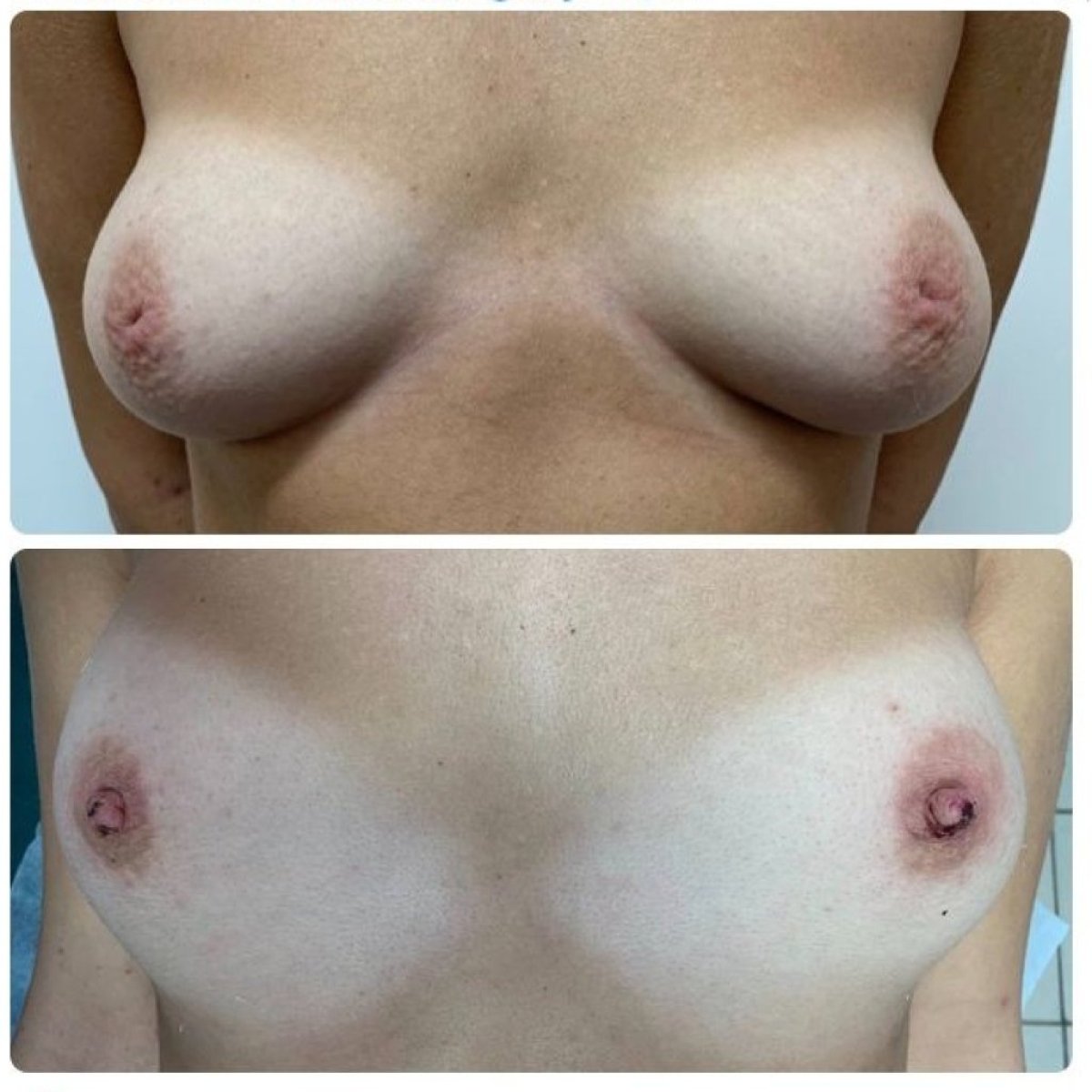 Resultados de corrección de pezones antes y después en Yurchenko Plastic Surgery Team Kyiv