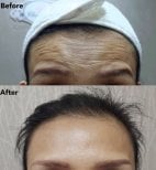 Przed i po botoksie w Charismma Clinic, efekt wygładzenia zmarszczek czoła