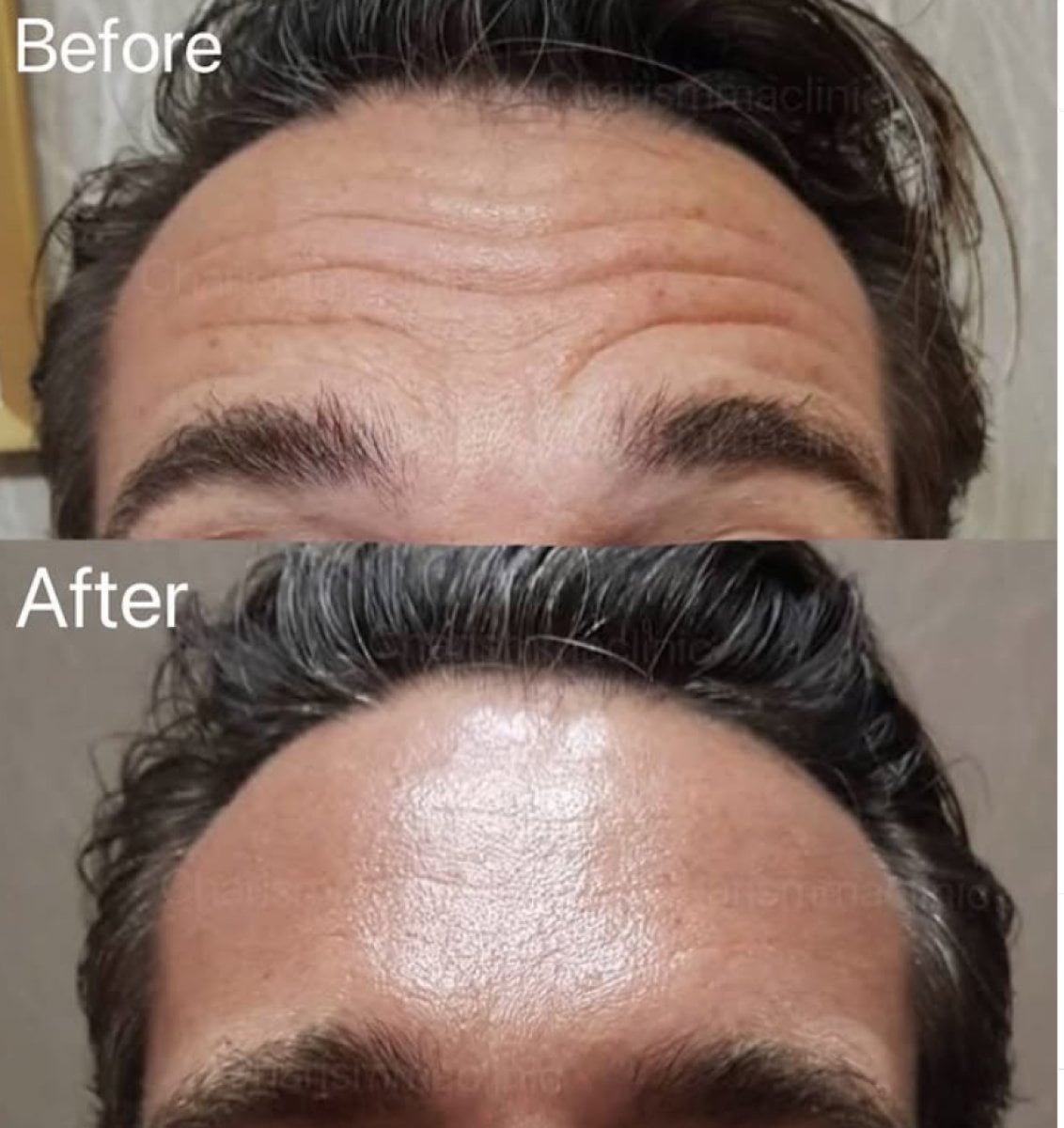 قبل وبعد حقن البوتوكس في Charismma Clinic، تقليل تجاعيد الجبهة