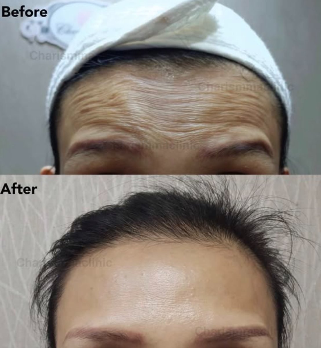 Resultados de inyecciones de botox en Charismma Clinic: antes y después, frente más lisa