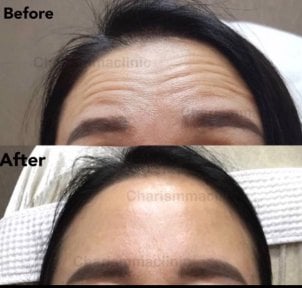 Before and after Botox injections at Charismma Clinic, smoother forehead wrinkle reduction result