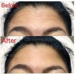 Before and after Botox injections at Charismma Clinic – smoother forehead wrinkle reduction result