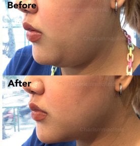 Efekty liposukcji podbródka przed i po w Charismma Clinic, poprawiony kontur