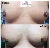 Результати збільшення грудей до і після в Charismma Clinic, покращена форма грудей