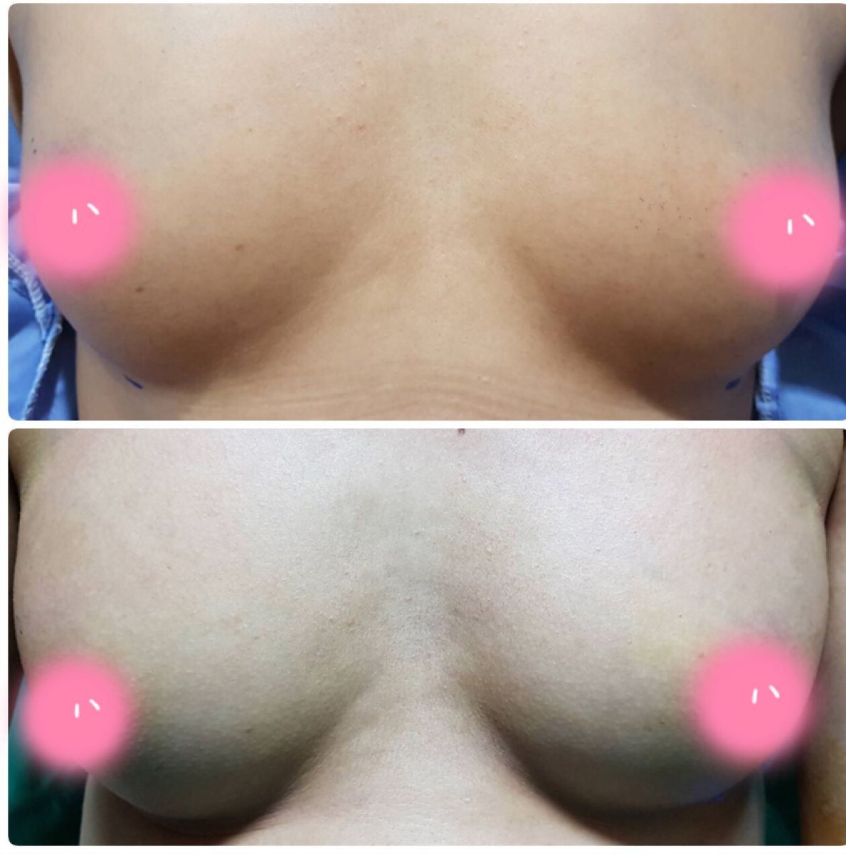 Résultats avant/après augmentation mammaire à Charismma Clinic, volume des seins accru