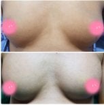 Результати до і після збільшення грудей у Charismma Clinic, покращений об'єм грудей