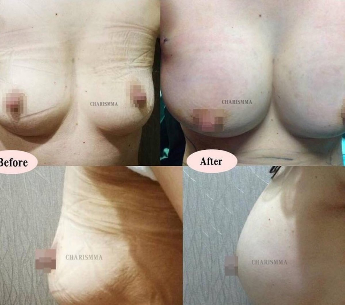 Résultats avant et après augmentation mammaire à Charismma Clinic, volume des seins accru