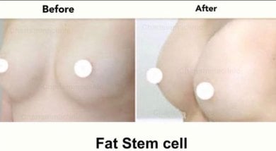 Before and after breast augmentation with fat stem cells at Charismma Clinic, visible results