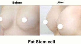 Before and after breast augmentation with fat stem cells at Charismma Clinic, visible results
