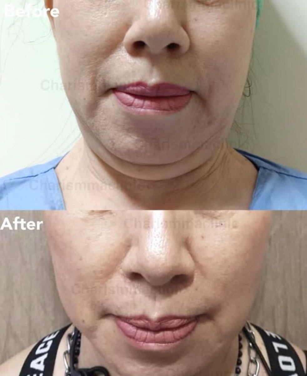 Resultados de liposucción de mentón antes y después en Charismma Clinic, contorno mejorado