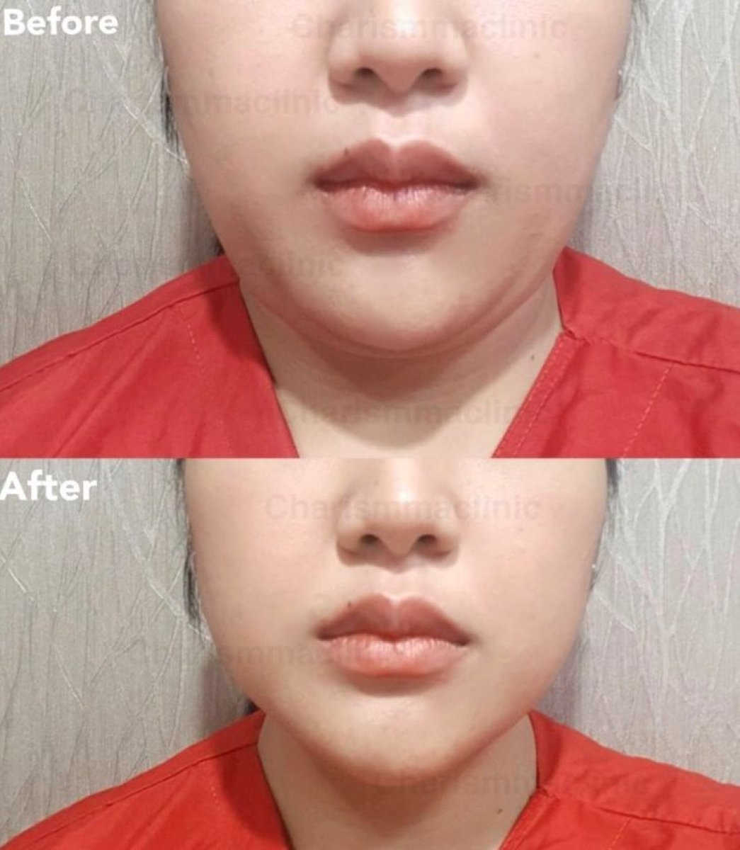 Resultados de liposucción de mentón antes y después en Charismma Clinic, contorno mejorado