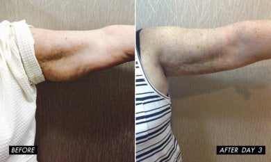 Before and after upper arm liposuction results at Charismma Clinic, visible contour improvement