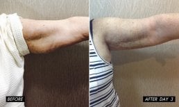 Before and after upper arm liposuction results at Charismma Clinic, visible contour improvement