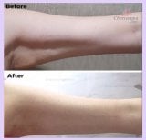 Before and after upper arm liposuction results at Charismma Clinic, improved arm contour