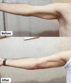 Resultados de liposucción de brazo antes y después en Charismma Clinic, contorno mejorado