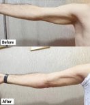 Resultados de liposucción de brazo antes y después en Charismma Clinic, contorno mejorado