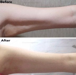 Resultados de liposucción de brazo antes y después en Charismma Clinic, contorno mejorado