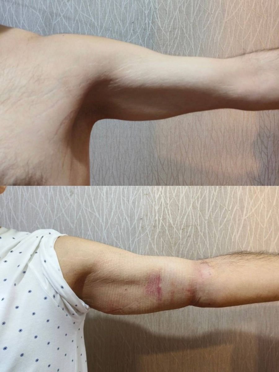 Результати ліпосакції верхньої частини руки до і після в Charismma Clinic, покращений контур